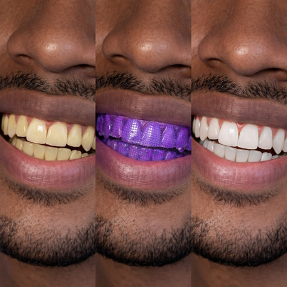 KB.Smile Pro Teeth Whitening Strips